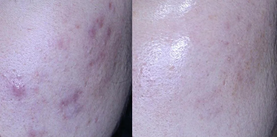 아리엘의원 포텐자+엑소좀+레이저 시술 전후 비교