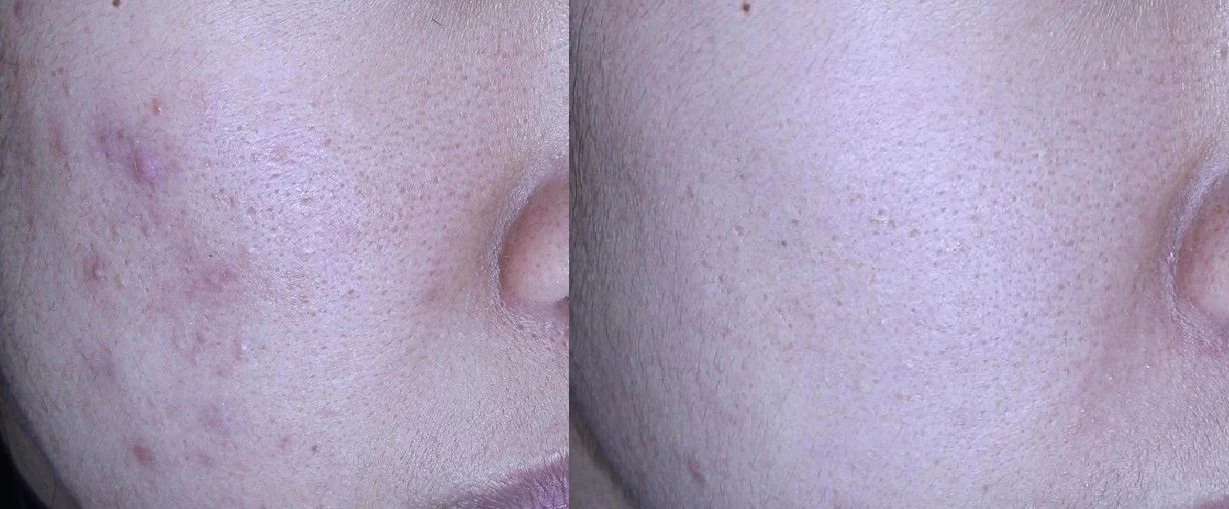 아리엘의원 포텐자+엑소좀+레이저 시술 전후 비교