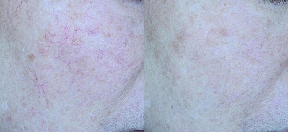 아리엘의원 혈관레이저 시술 전후 비교