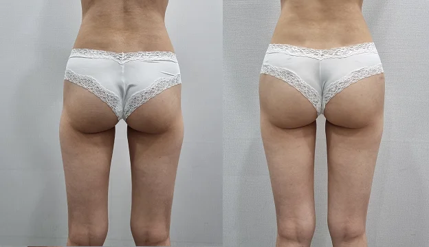 아리엘의원 애플힙필러 시술 전후 비교