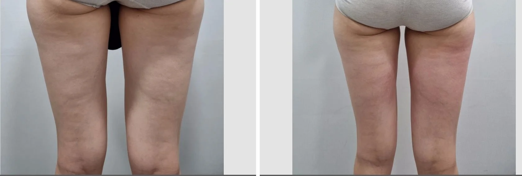 아리엘의원 바디온다 시술 전후 비교