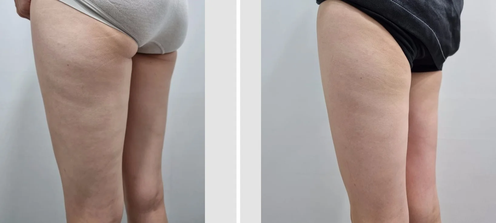 아리엘의원 바디온다 시술 전후 비교