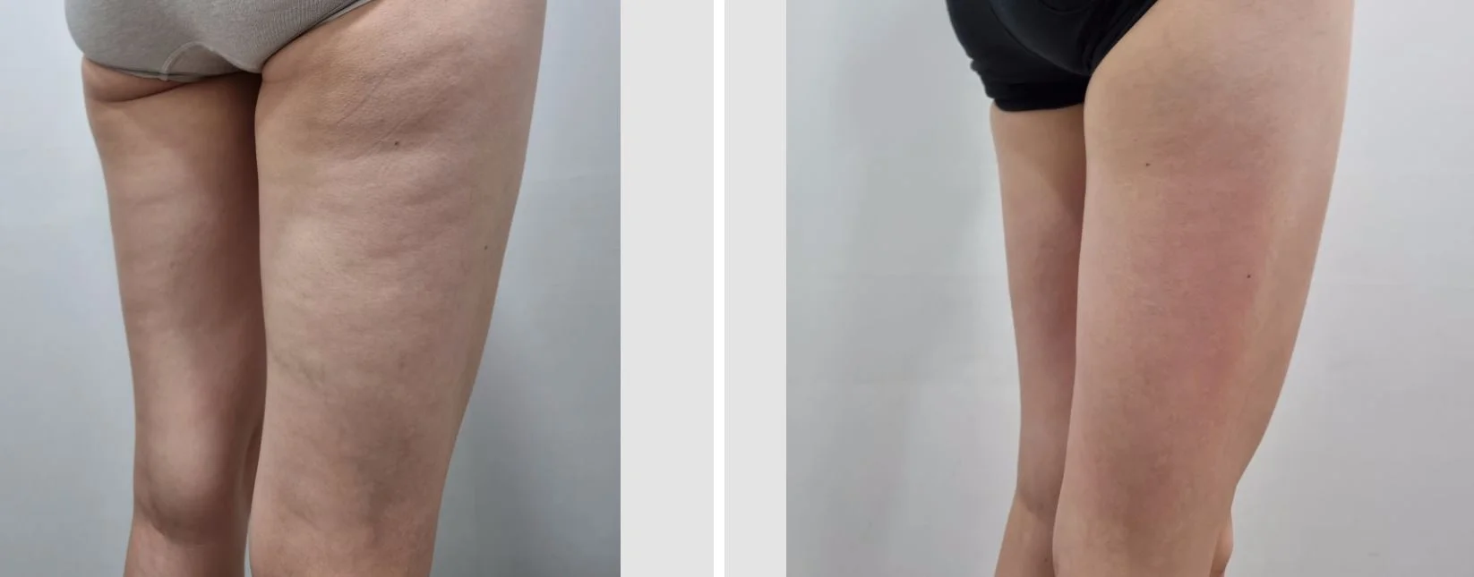 아리엘의원 바디온다 시술 전후 비교