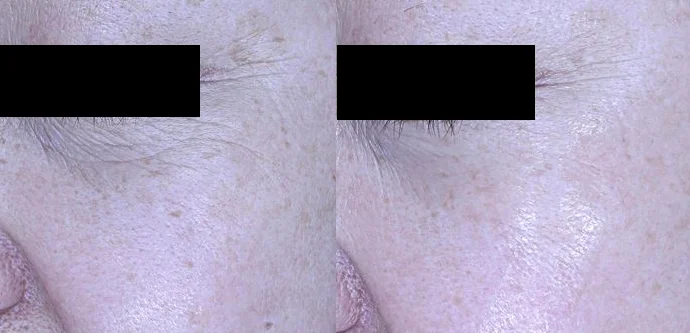 아리엘의원 눈가보톡스 시술 전후 비교