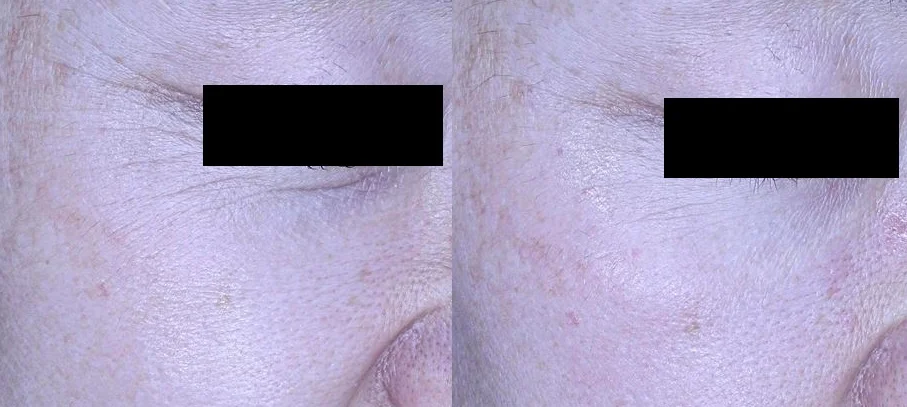 아리엘의원 눈가보톡스 시술 전후 비교