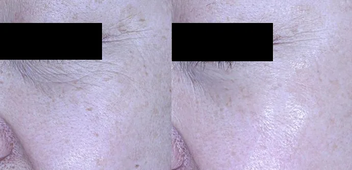 아리엘의원 눈가 보톡스 전후 비교 사진 1