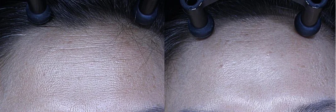 아리엘의원 이마보톡스 시술 전후 비교