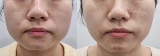아리엘의원 턱보톡스 시술 전후 비교
