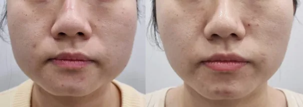 아리엘의원 턱 보톡스 전후 비교 사진 1
