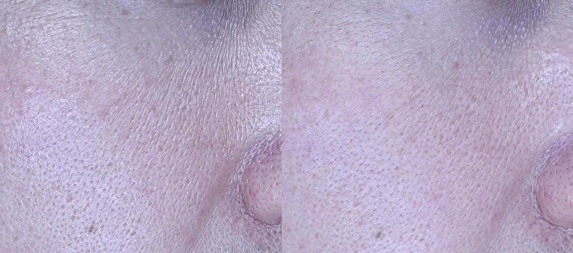 아리엘의원 포텐자+쥬베룩+레이저 시술 전후 비교