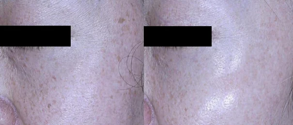 아리엘의원 포텐자+쥬베룩+레이저 시술 전후 비교