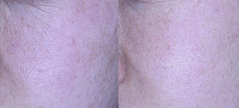 아리엘의원 포텐자+쥬베룩+레이저 시술 전후 비교