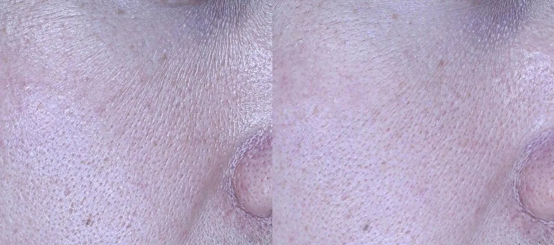 아리엘의원 포텐자+쥬베룩+레이저 복합 치료 전후 비교 사진 1