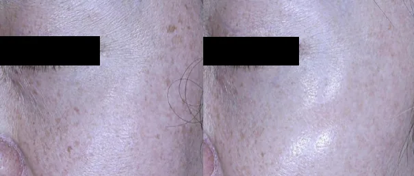 아리엘의원 포텐자+쥬베룩+레이저 복합 치료 전후 비교 사진 2