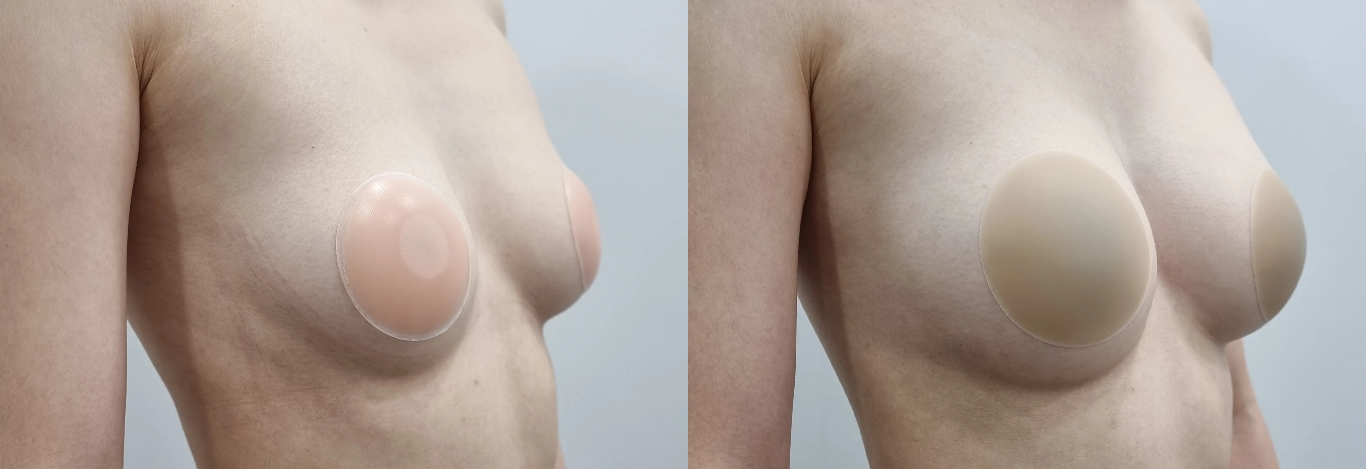 아리엘의원 글램업필러 시술 전후 비교