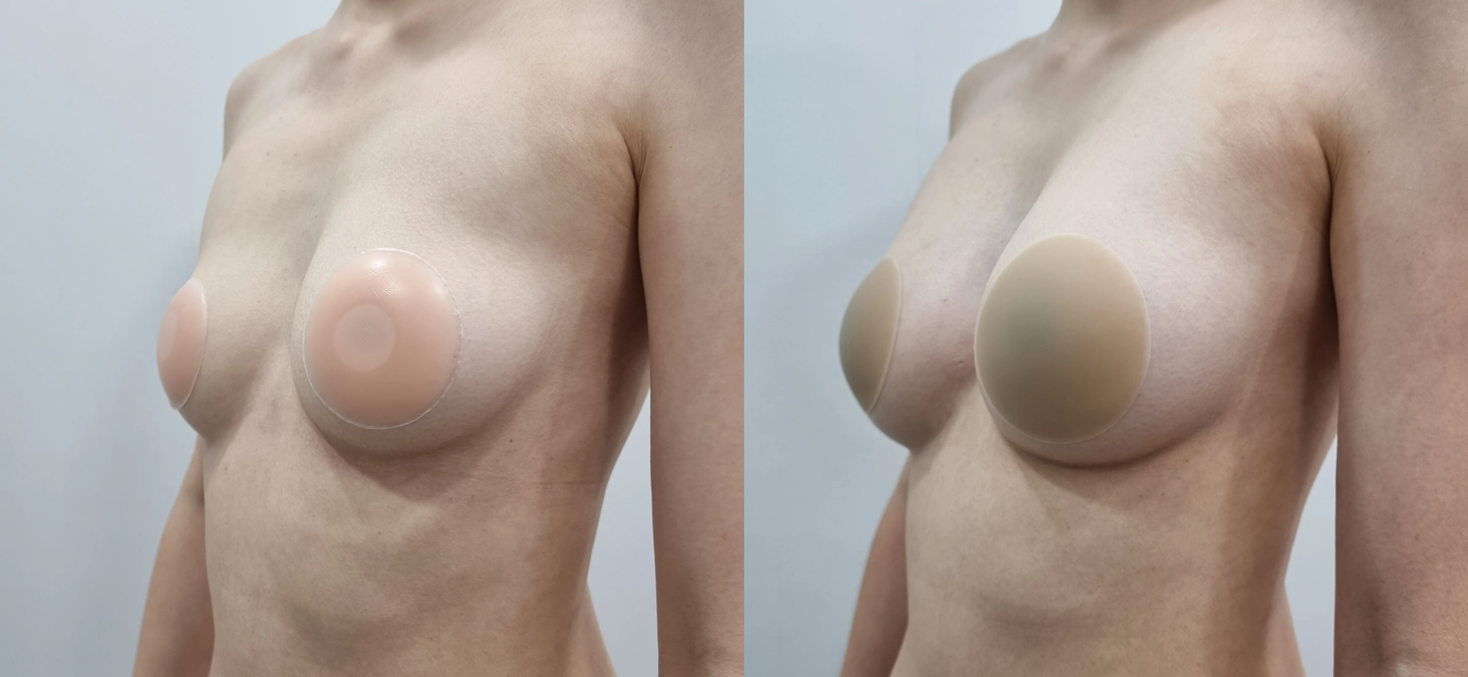 아리엘의원 글램업필러 시술 전후 비교