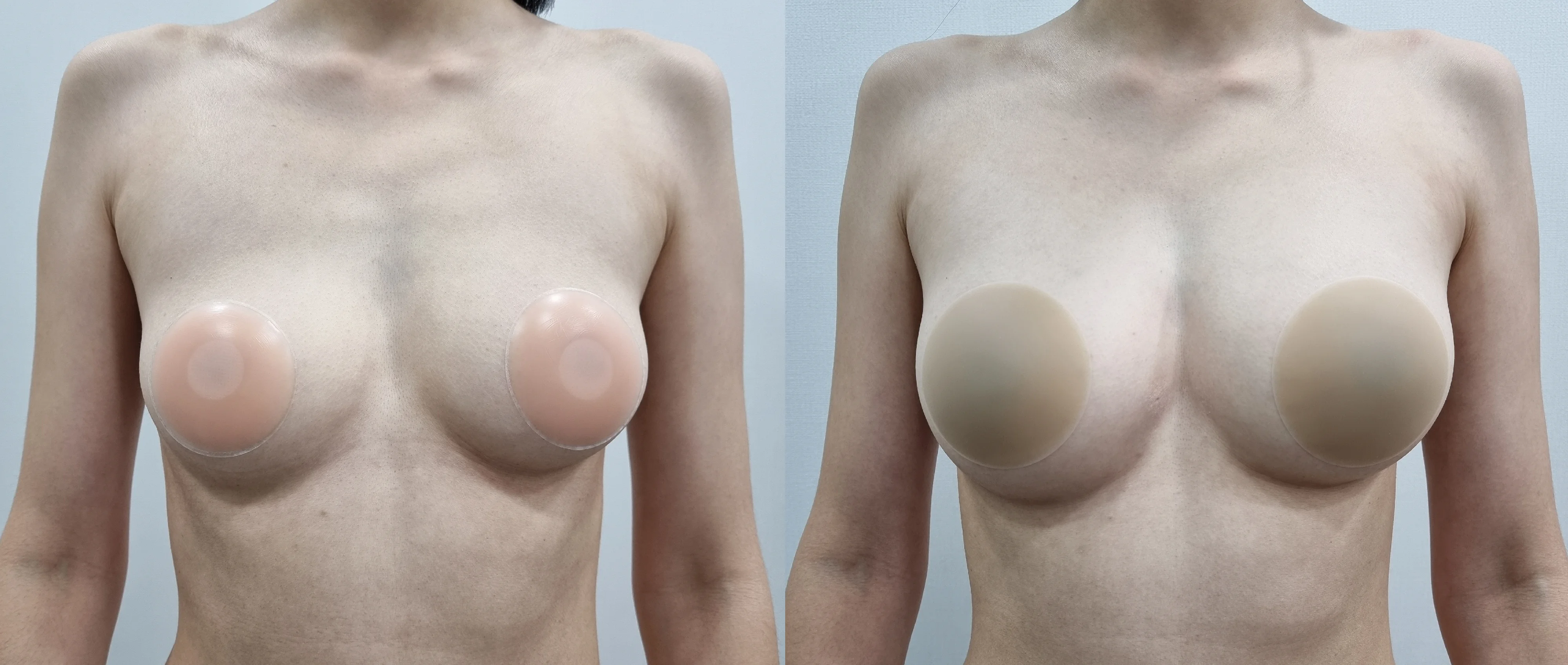 아리엘의원 글램업필러 시술 전후 비교