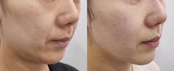 아리엘의원 쥬베룩 볼륨 눈밑·앞볼·턱끝 시술 전후 비교 사진 1