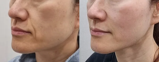 아리엘의원 쥬베룩 볼륨 눈밑·앞볼·마리오네트 시술 전후 비교 사진 1
