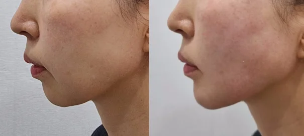 아리엘의원 쥬베룩볼륨 시술 전후 비교