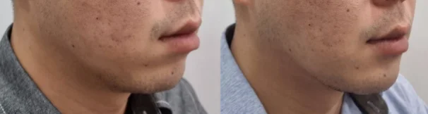 아리엘의원 쥬베룩볼륨 시술 전후 비교