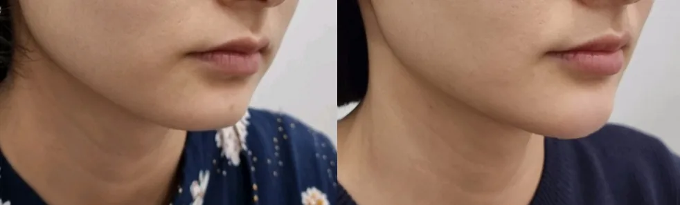 아리엘의원 쥬베룩 볼륨 턱끝 시술 전후 비교 사진 1