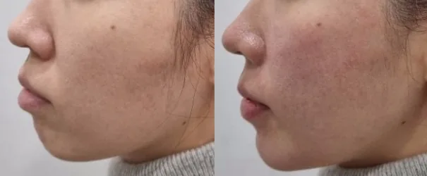 아리엘의원 쥬베룩 볼륨 턱끝 시술 전후 비교 사진 2