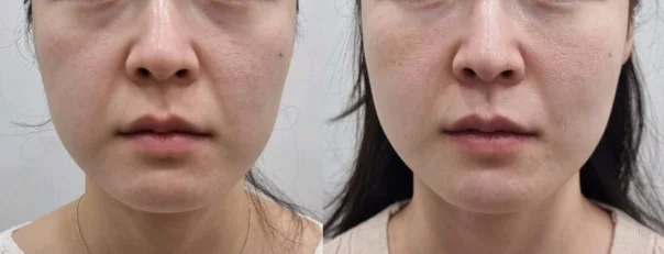 아리엘의원 쥬베룩볼륨 시술 전후 비교