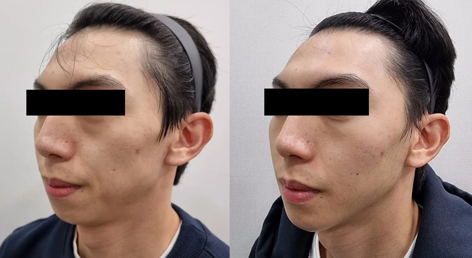 아리엘의원 쥬베룩볼륨 시술 전후 비교