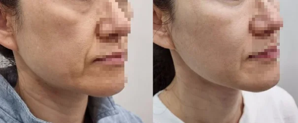 아리엘의원 쥬베룩볼륨 시술 전후 비교