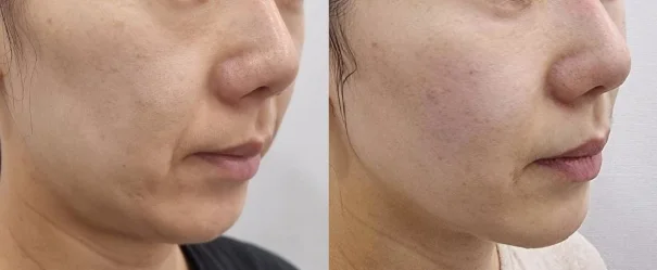 아리엘의원 쥬베룩볼륨 눈밑,앞볼,옆볼,마리오네트,턱끝 시술 전후 비교 사진 (시술 2024-06-18 → 촬영 2024-10-14, 시술 후 약 4개월)