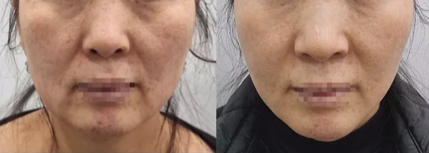 아리엘의원 온다 시술 전후 비교