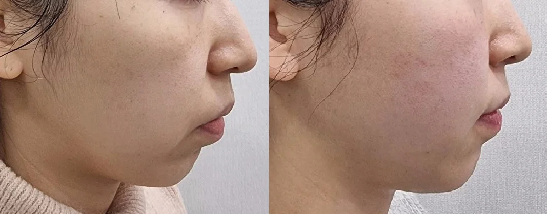 아리엘의원 온다 시술 전후 비교