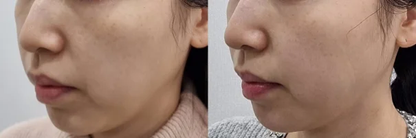 아리엘의원 온다 시술 전후 비교