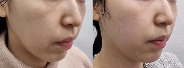 아리엘의원 온다 시술 전후 비교