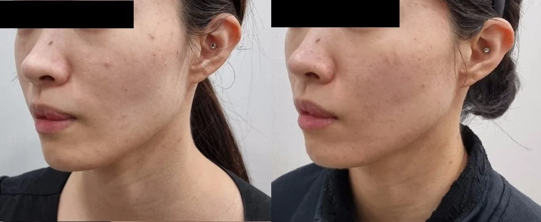 아리엘의원 레비나스+쥬볼 시술 전후 비교