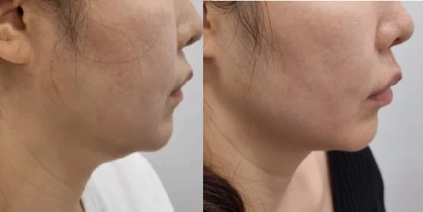 아리엘의원 온다 시술 전후 비교