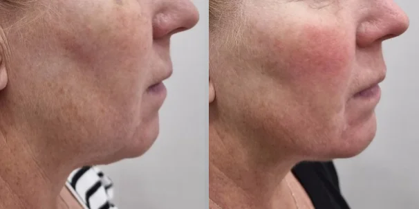 아리엘의원 온다 시술 전후 비교