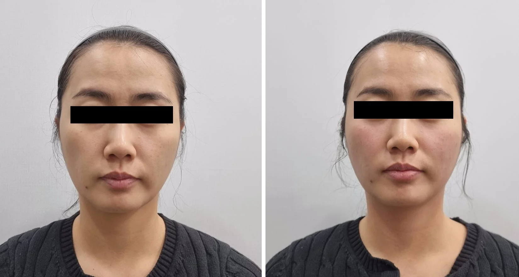 아리엘의원 온다레비나스 시술 전후 비교