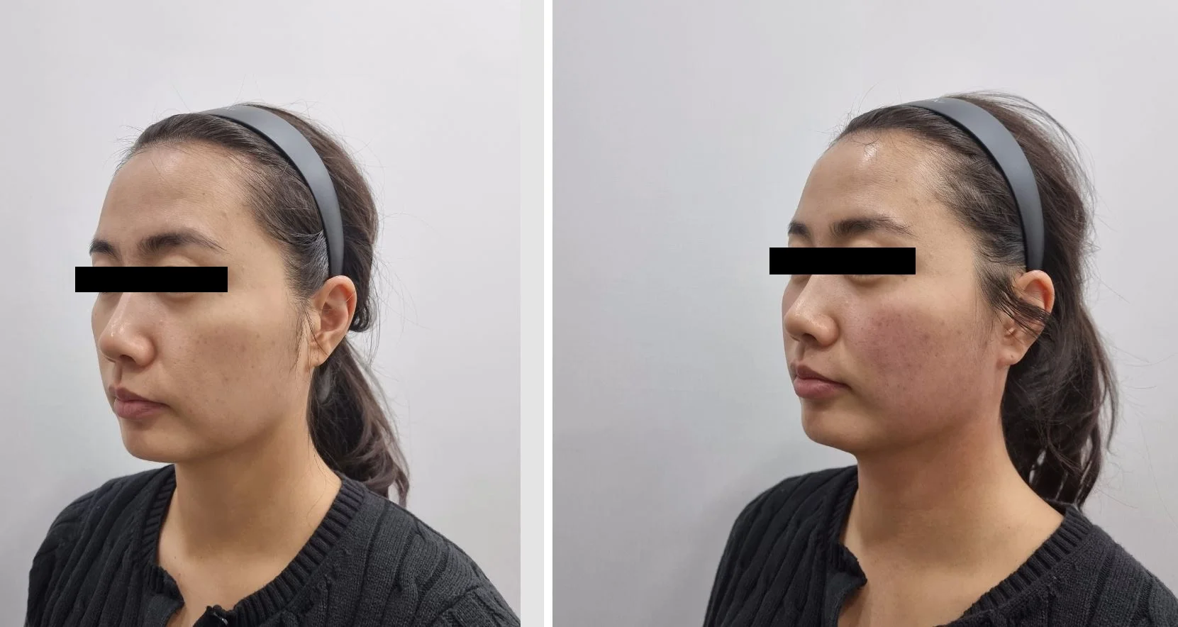 아리엘의원 온다레비나스 시술 전후 비교