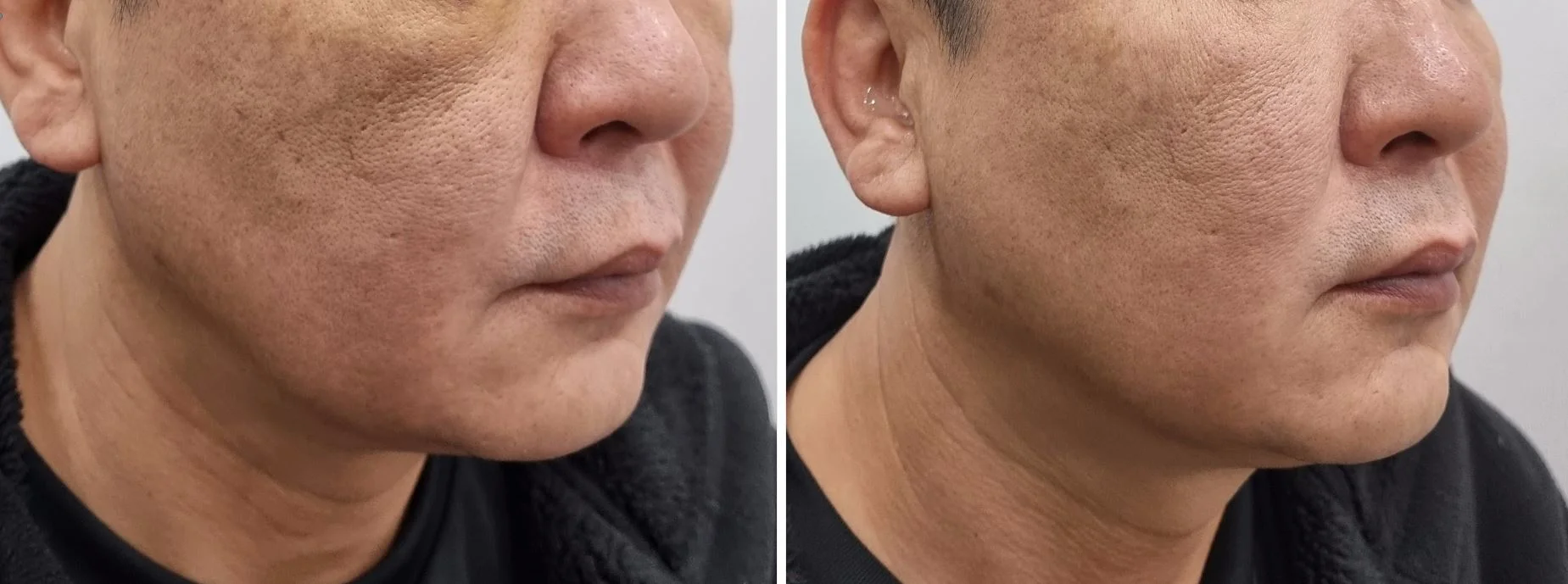 아리엘의원 온다,레비나스,브이로 시술 전후 비교