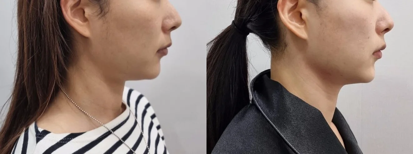 아리엘의원 온다,레비나스,브이로 시술 전후 비교