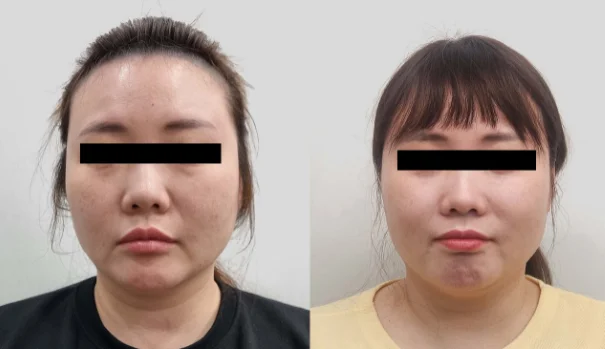 아리엘의원 온다,레비나스,브이로 시술 전후 비교