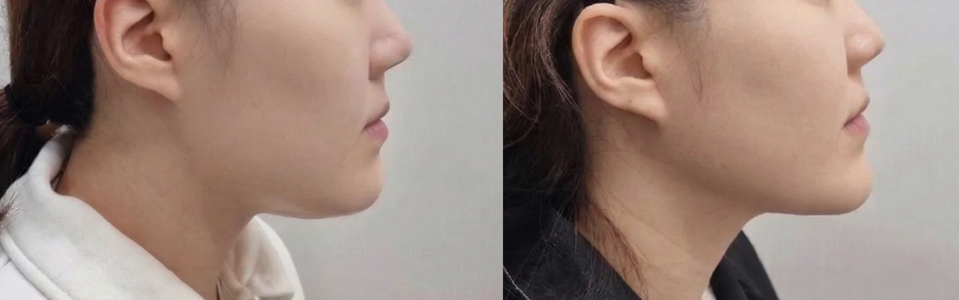 아리엘의원 온다,레비나스,브이로 시술 전후 비교