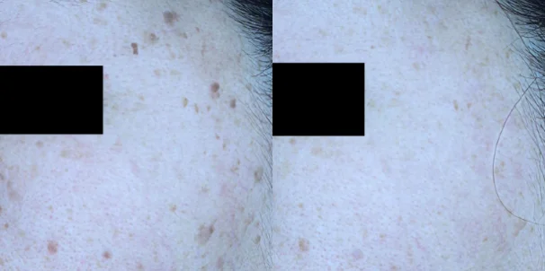 아리엘의원 맞춤레이저 시술 전후 비교