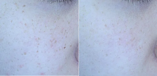 아리엘의원 맞춤레이저 시술 전후 비교