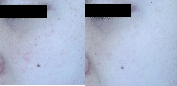 아리엘의원 맞춤레이저 시술 전후 비교