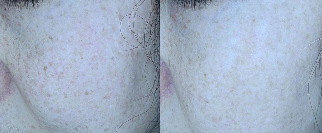 아리엘의원 맞춤레이저 시술 전후 비교