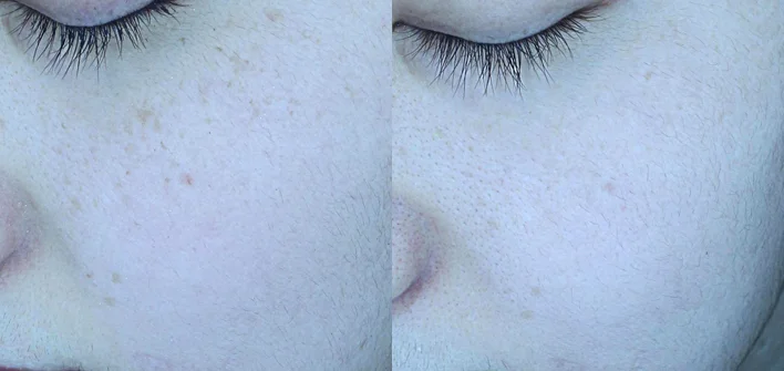 아리엘의원 맞춤레이저 시술 전후 비교