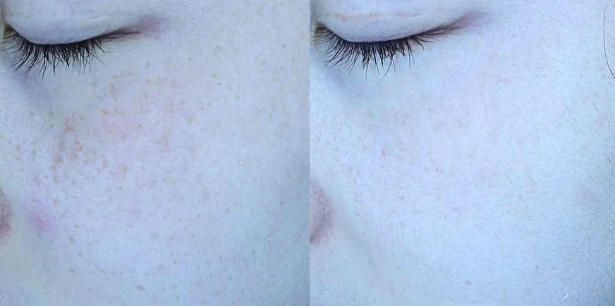 아리엘의원 맞춤레이저 시술 전후 비교